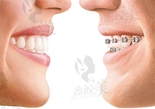 罗慕矫正器是哪国的