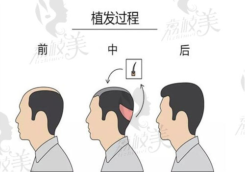 斑秃cgf治疗会出现狂脱期吗