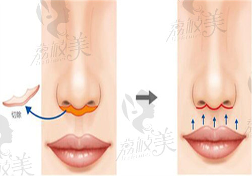 廣州人中縮短術(shù)哪里做得好