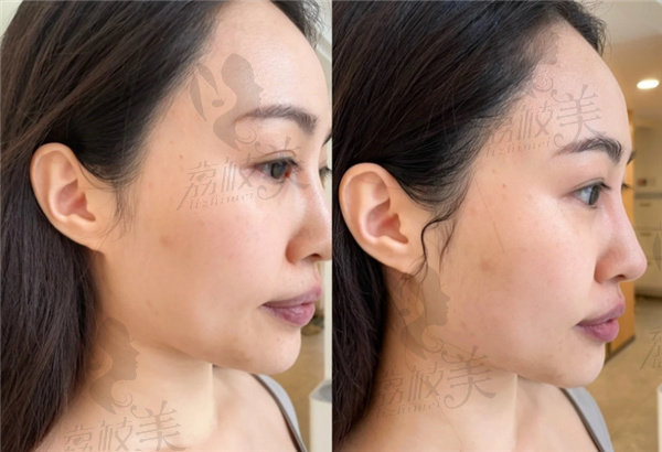 轻薄针是不是就是溶脂 针