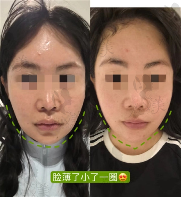 轻薄针是不是就是溶脂 针