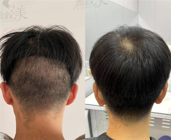 南京领秀植发价格