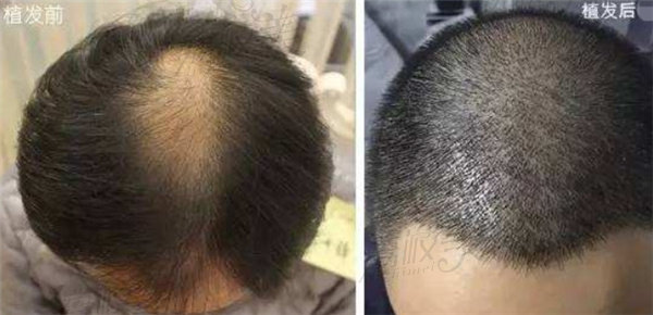 南京领秀植发价格