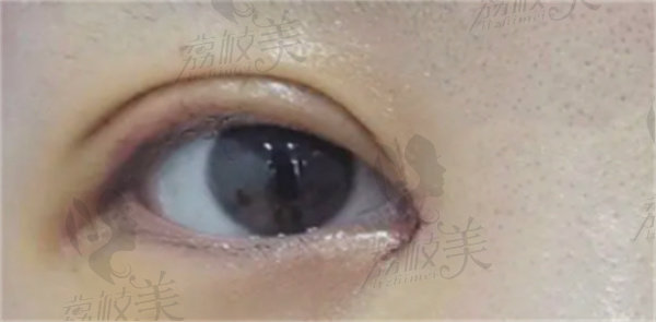 陈杰做开眼角