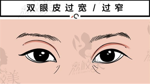 沈阳董红星做双眼皮怎么样