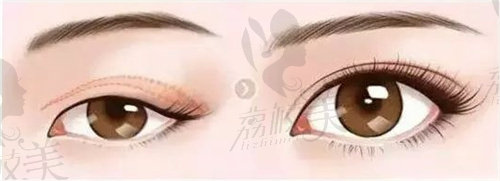 沈阳董红星双眼皮修复怎么样