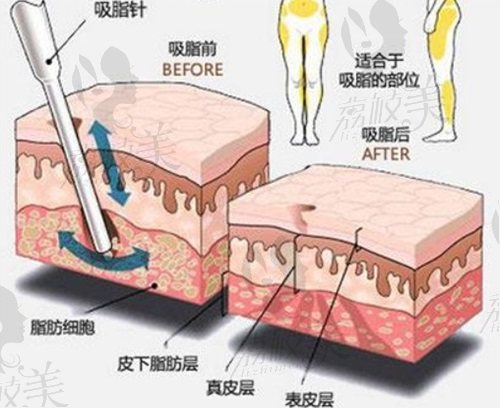 深圳藝星黃海俠抽脂怎么樣？