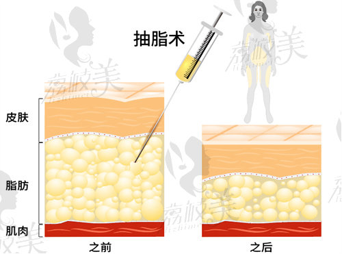 华美整形美容医院价目表