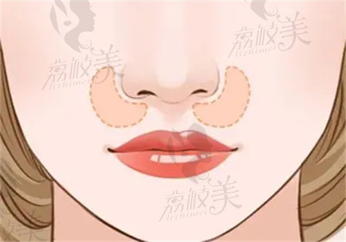 黄江泊医生做鼻子成效很不错