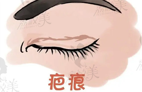 北京韩勋双眼皮修复价格
