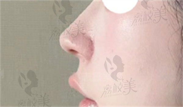 荆志辉做鼻修复