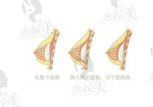 徐淑卿脂肪隆胸怎么样