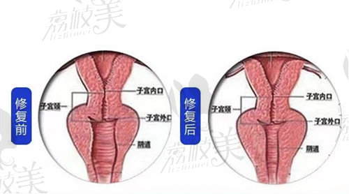 北京紧缩手术大概多少钱