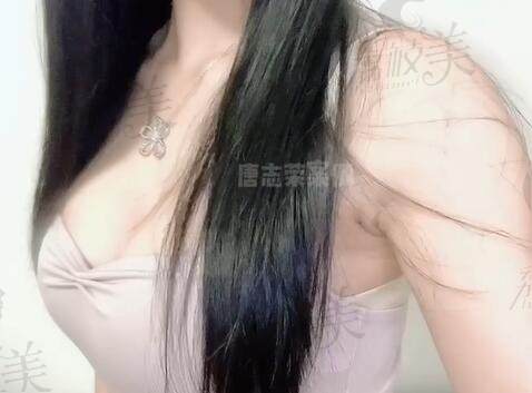 唐志荣医生隆胸实例