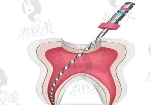 麗江德柏口腔張千根管治療怎么樣