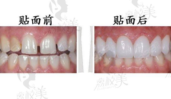 福州登特口腔貼面多少錢