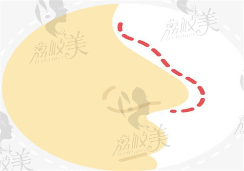 刘彦军做鼻梁风格偏自然