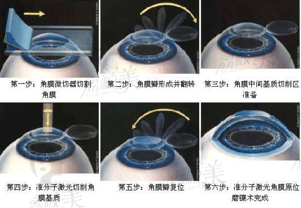 鄭州美視美康眼科醫(yī)院近視手術(shù)怎么樣