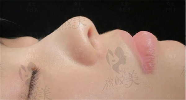 周维做鼻部修复