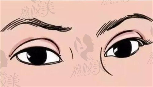 韩勋修复双眼皮成功几率高吗