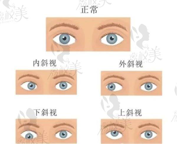 哈尔滨看斜视哪个医院好