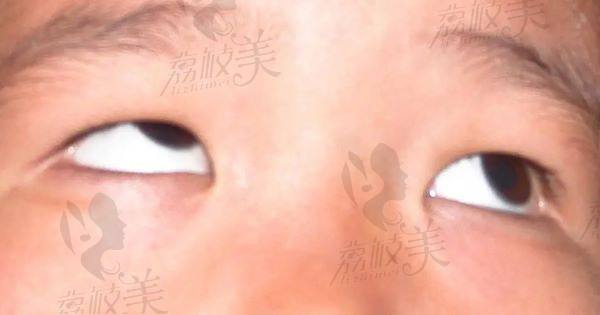 哈尔滨爱尔眼科医院看斜视怎么样