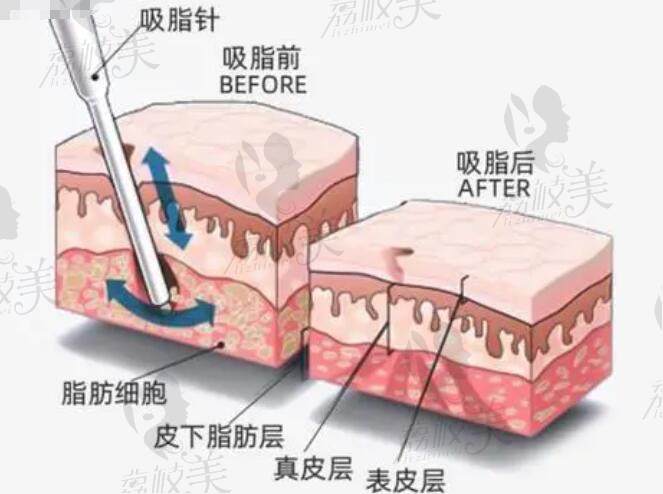 2025八大处整形吸脂手术收费标准