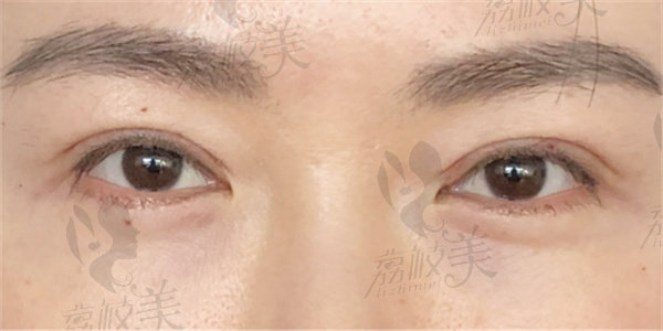 南昌汉美医疗美容门诊部林杰做眼部修复