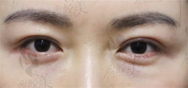 林杰做眼部修复