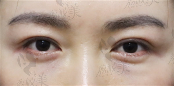 南昌汉美医疗美容门诊部做眼部修复