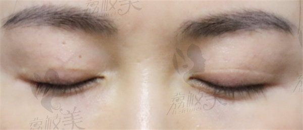 南昌汉美医疗美容门诊部林杰做眼部修复