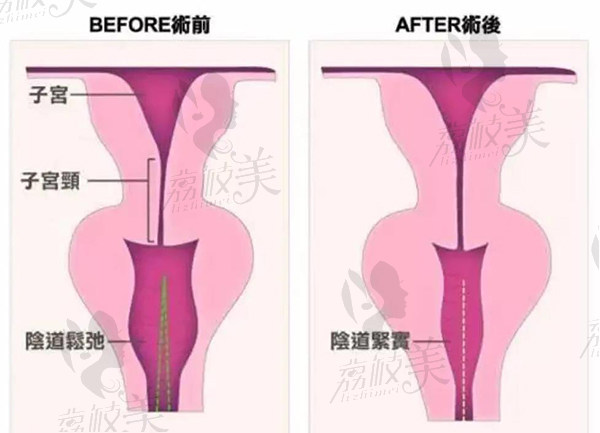 重庆私密紧缩术医院哪家好