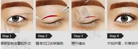 哈爾濱超龍哪個(gè)醫(yī)生做修復(fù)雙眼皮