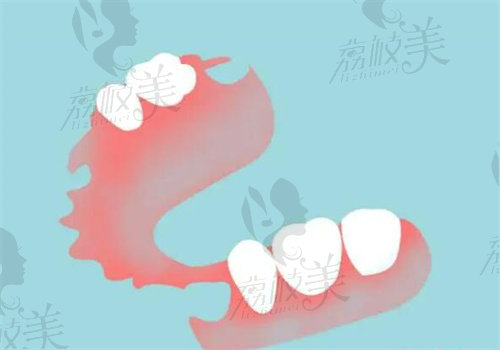 金華樂(lè)莎莎口腔高安分做半口樹(shù)脂活動(dòng)義齒相關(guān)優(yōu)勢(shì)