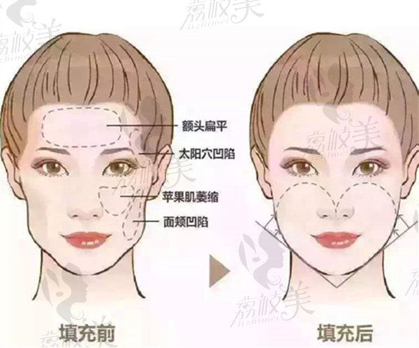 面部注射美容