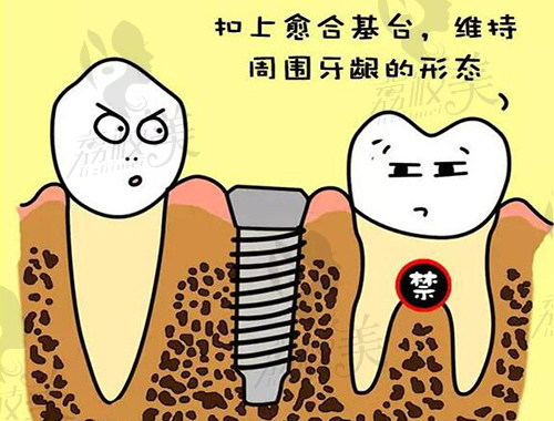 意大利bb种植体使用寿命