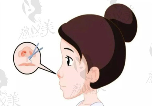 张金明医生擅长鼻整形