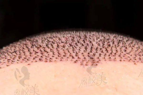 刘维医生植发技术怎么样