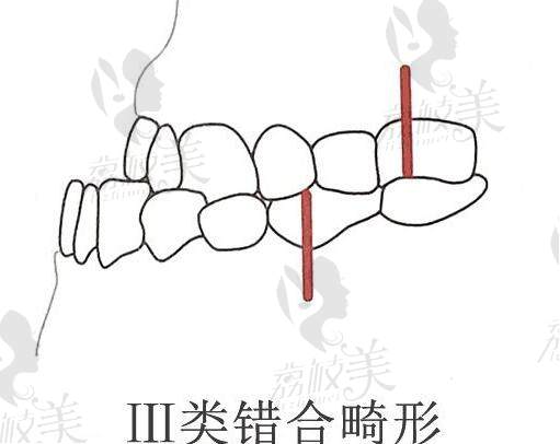 太原可睦口腔隐适美隐形矫正价格