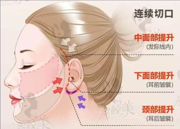 袁強(qiáng)拉皮手術(shù)費用
