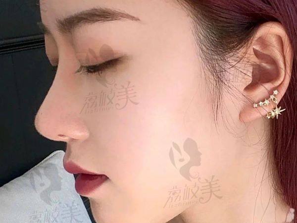 北京协和医院整形外科鼻部整形项目费用