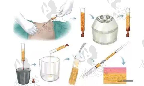 北京协和医院整形外科吸脂整形项目费用