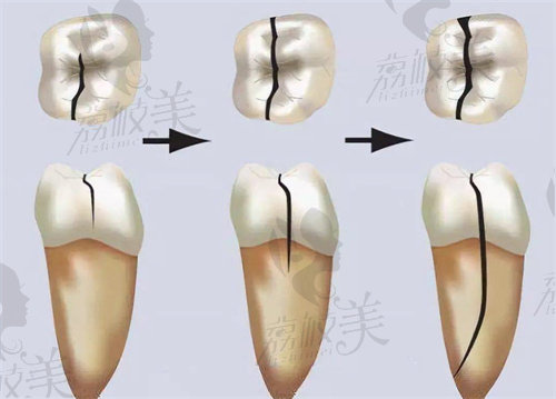 沈阳康贝佳口腔慕林林全瓷冠修复