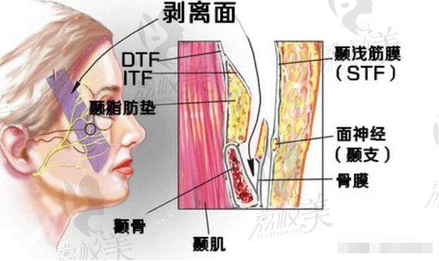微拉美4.0提升 和無痕筋膜提升區(qū)別在哪里