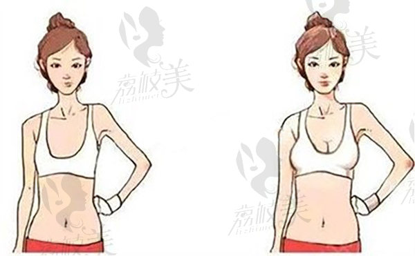 胸部整形