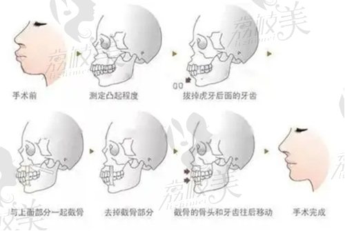 肖林医生双鄂矫正技术稳如山