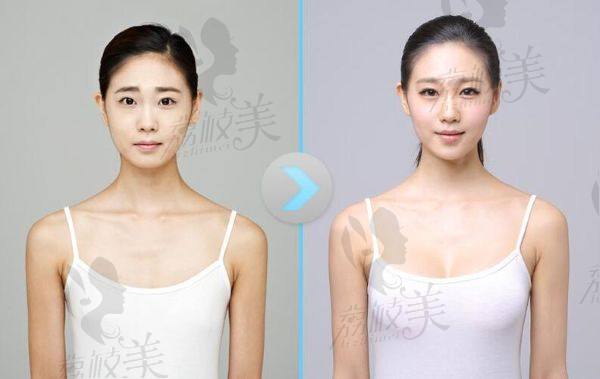 無(wú)錫施爾美王章霞隆胸怎么樣