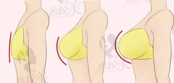 为什么栾杰医生的隆胸手术是这个“价位”