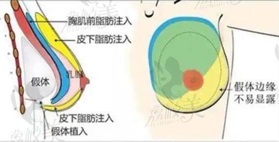 重慶華美豐胸手術一般多少錢