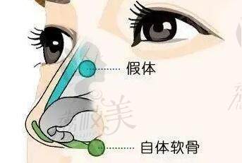 無錫施爾美姚義超做鼻子怎么樣